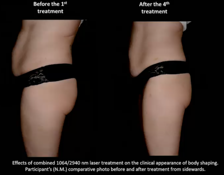 A lézeres zsírbontás hatékonyságát tesztelték a szegedi egyetemen