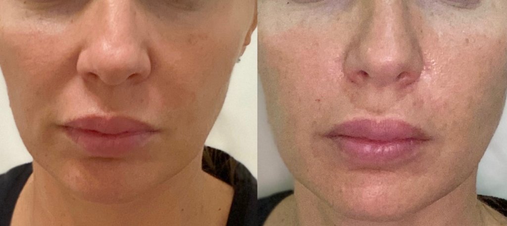 Hialuronsavas volumenpótlás