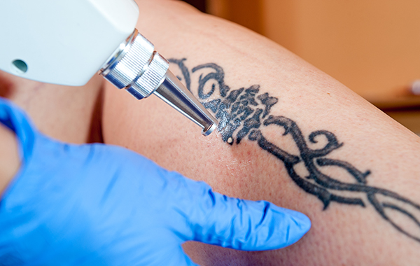 Medandbeauty tetovalas eltavolitas